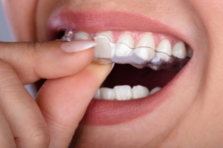 Invisalign in Squirrel Hill Invisalign in Pittsburgh